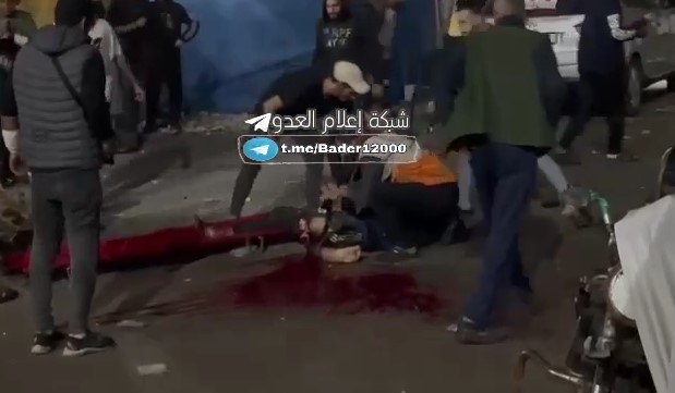 اصابة مع بتر قدم احد المصابين جراء قصف مشفى الشفاء في غزة