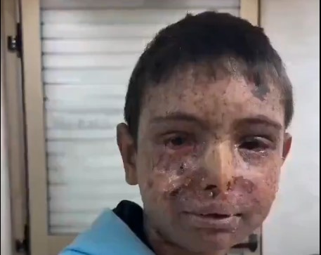 طفل فلسطيني مصاب بحروق في وجهه جراء العدوان الصهيوني على غزة